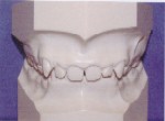 Overbite - Orthodontics