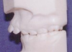 Overjet - Orthodontics